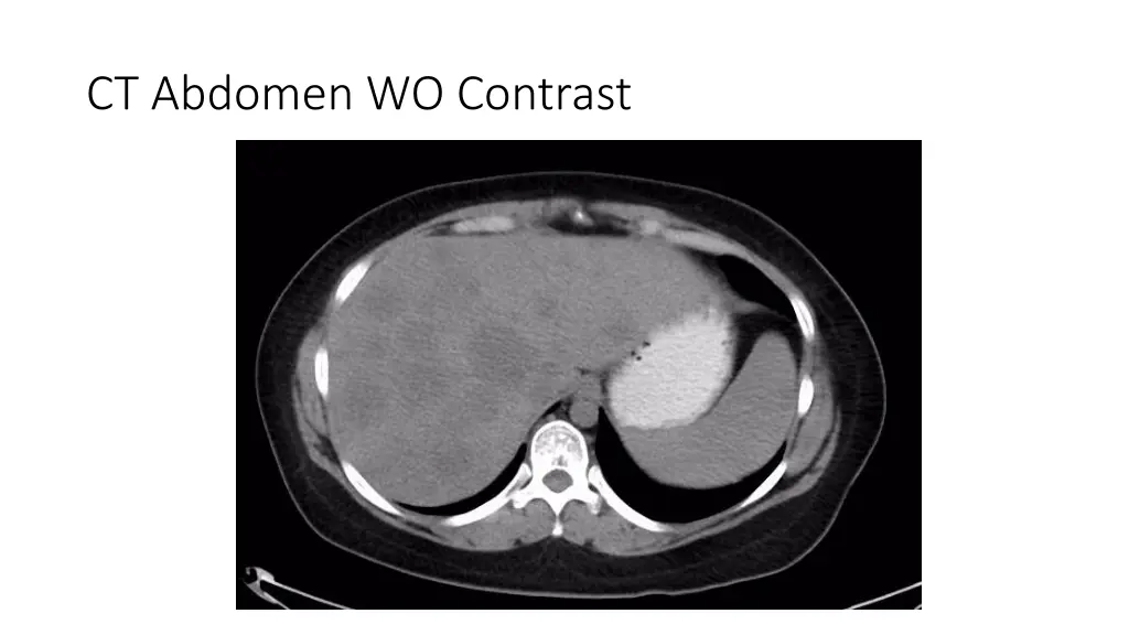 ct abdomen wo contrast