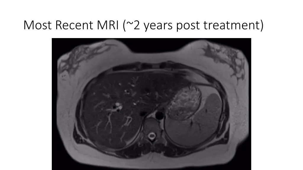 most recent mri 2 years post treatment