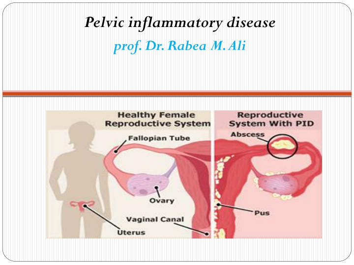 pelvic inflammatory disease prof dr rabea m ali