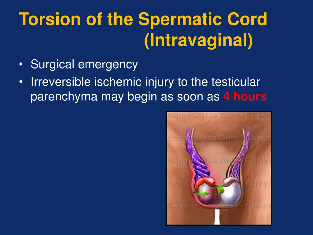 torsion of the spermatic cord intravaginal