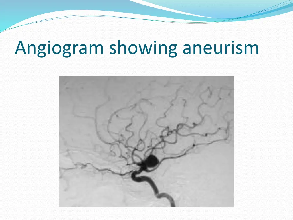 angiogram showing aneurism