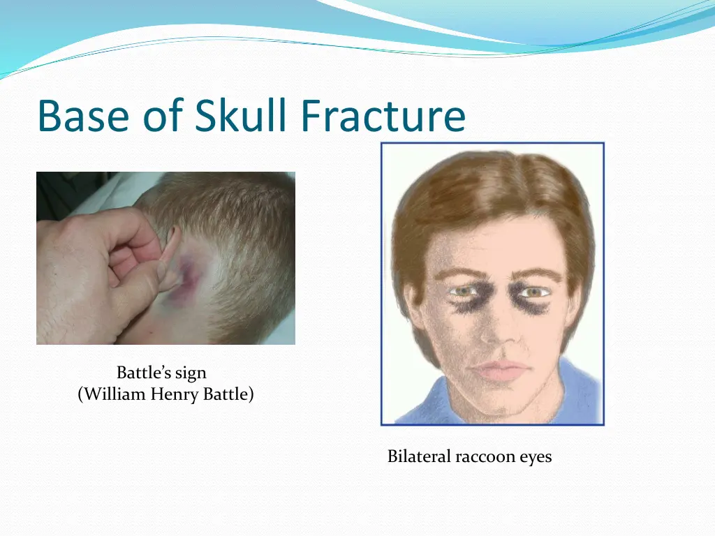 base of skull fracture