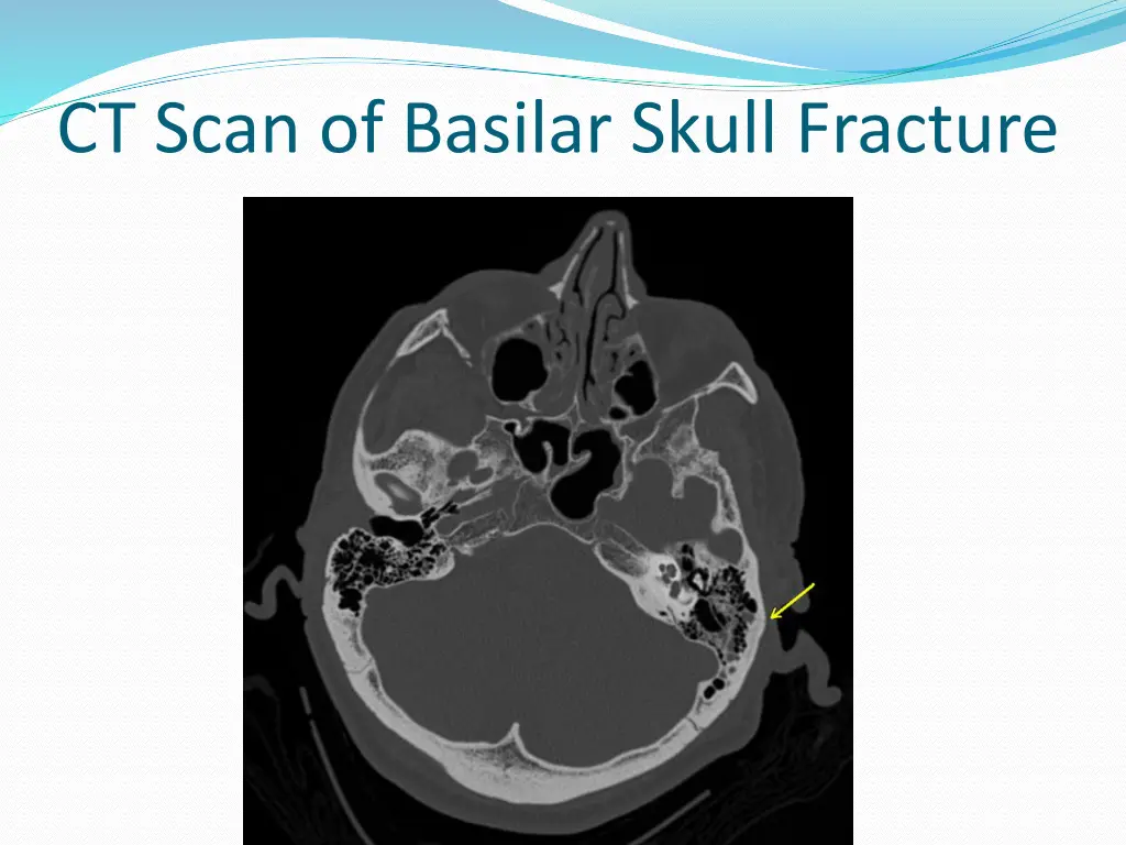 ct scan of basilar skull fracture