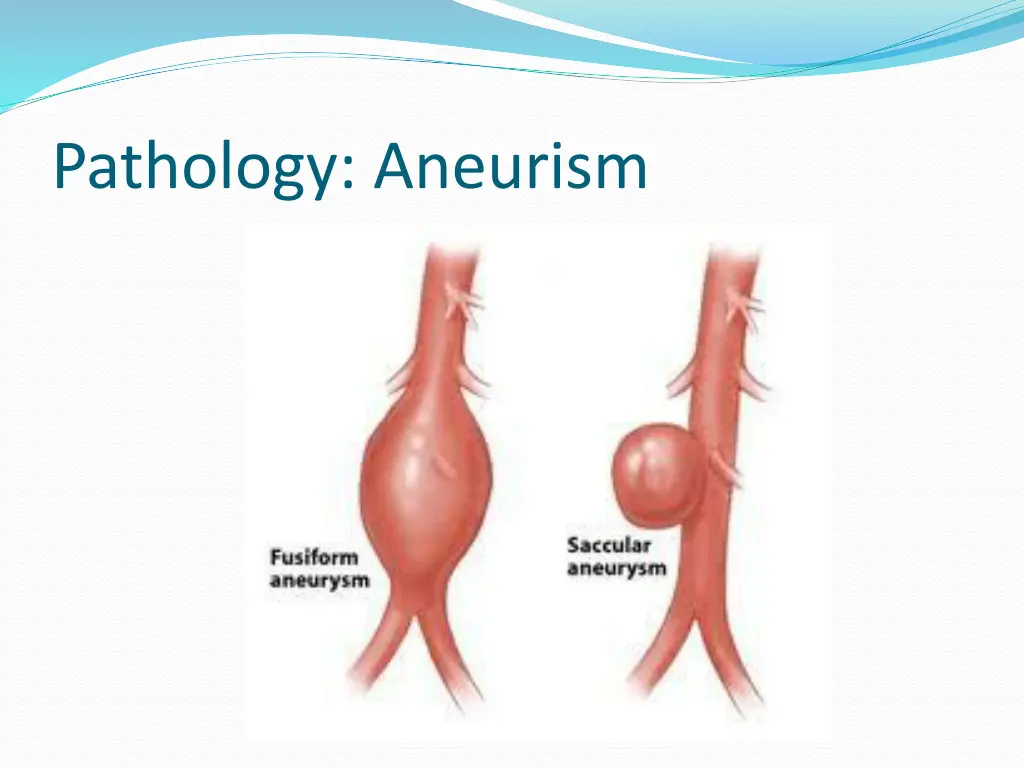 pathology aneurism