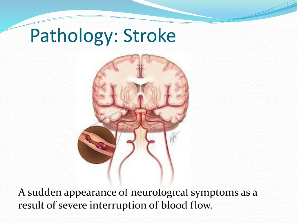 pathology stroke