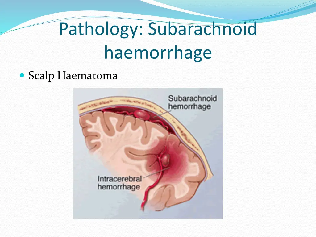 pathology subarachnoid haemorrhage