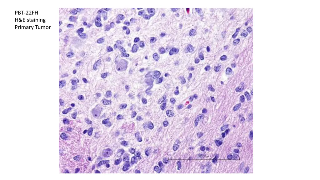 pbt 22fh h e staining primary tumor