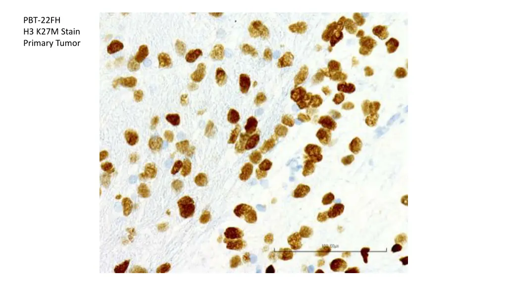 pbt 22fh h3 k27m stain primary tumor