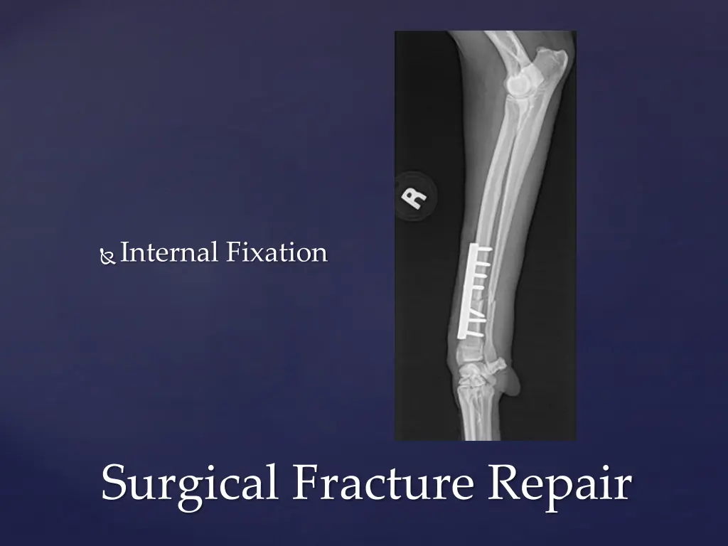 internal fixation