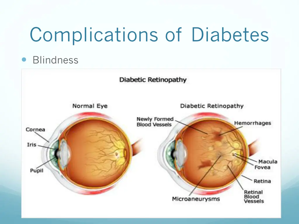 complications of diabetes 1