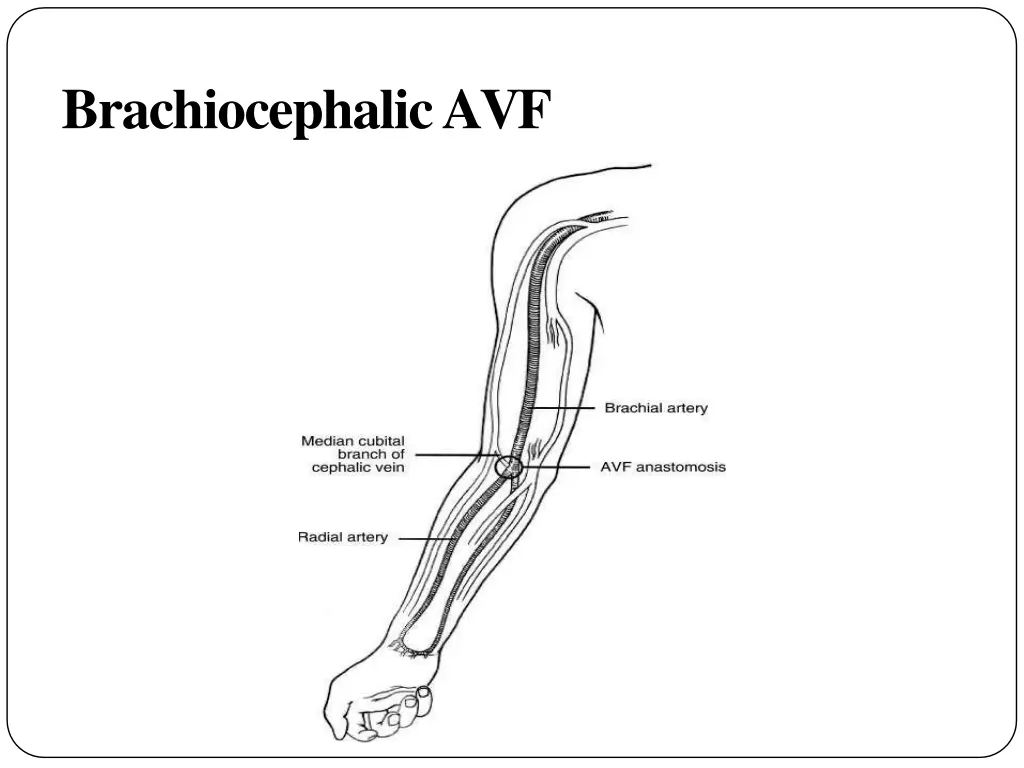 brachiocephalicavf