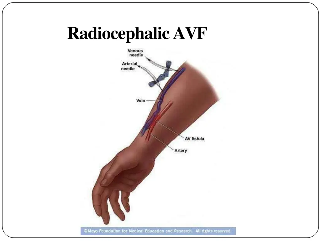 radiocephalicavf