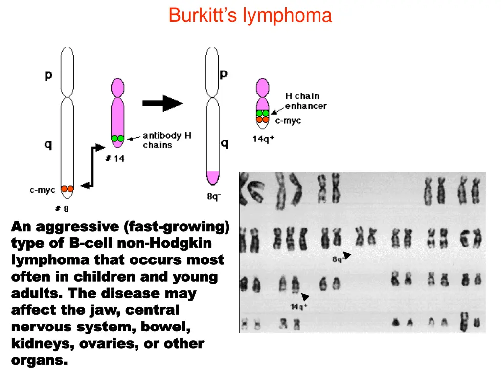 burkitt s lymphoma