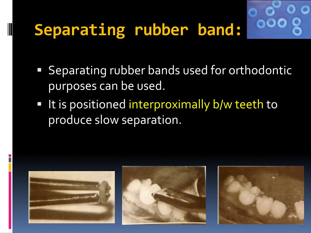 separating rubber band