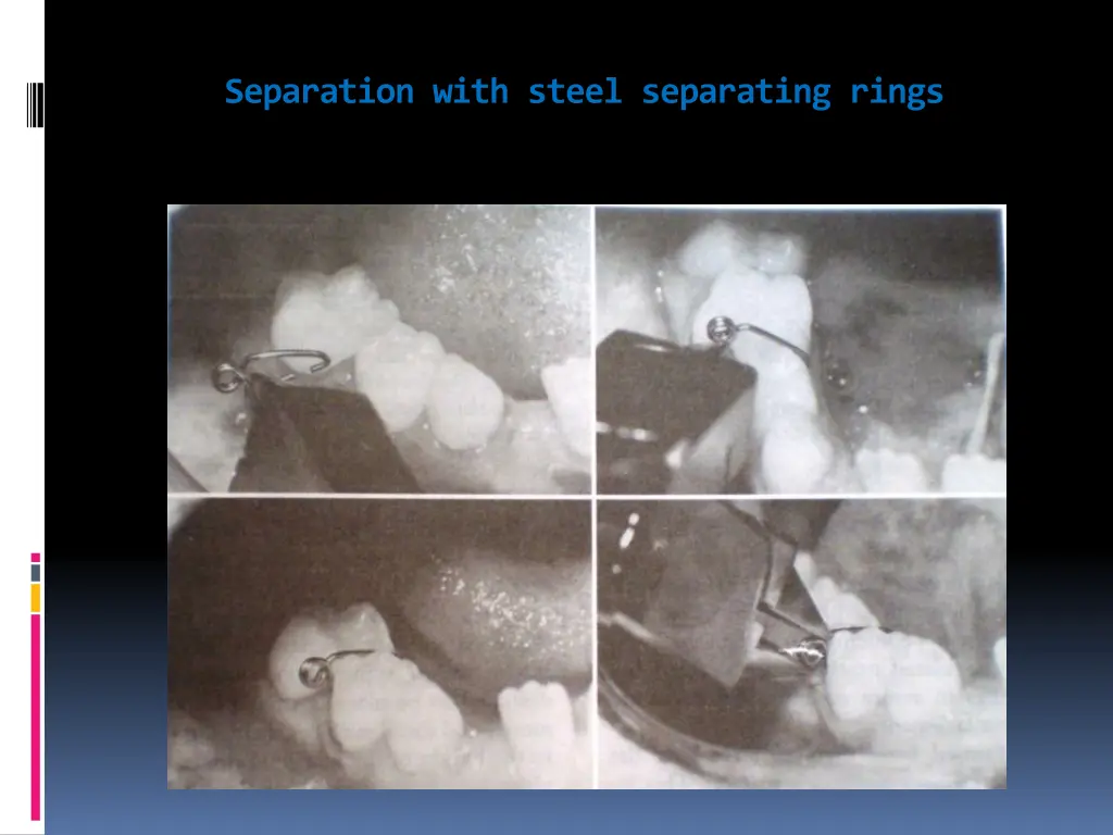 separation with steel separating rings