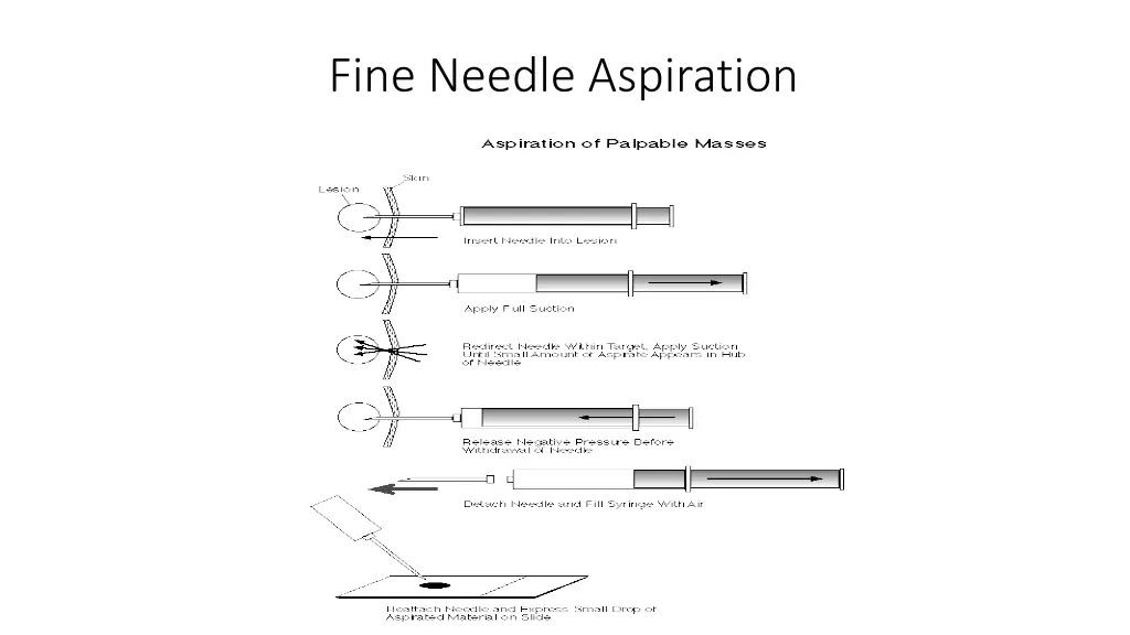 fine needle aspiration