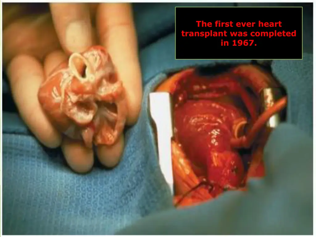 the first ever heart transplant was completed