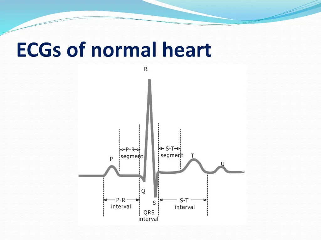 ecgs of normal heart