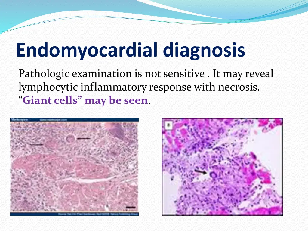 endomyocardial diagnosis