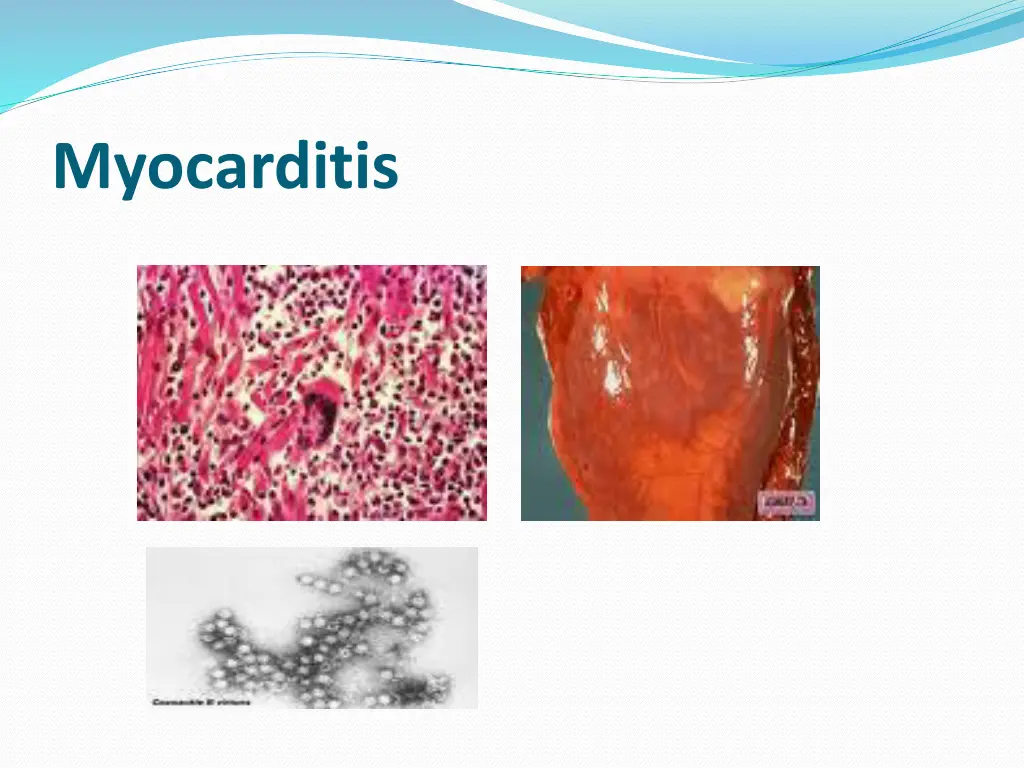 myocarditis 1