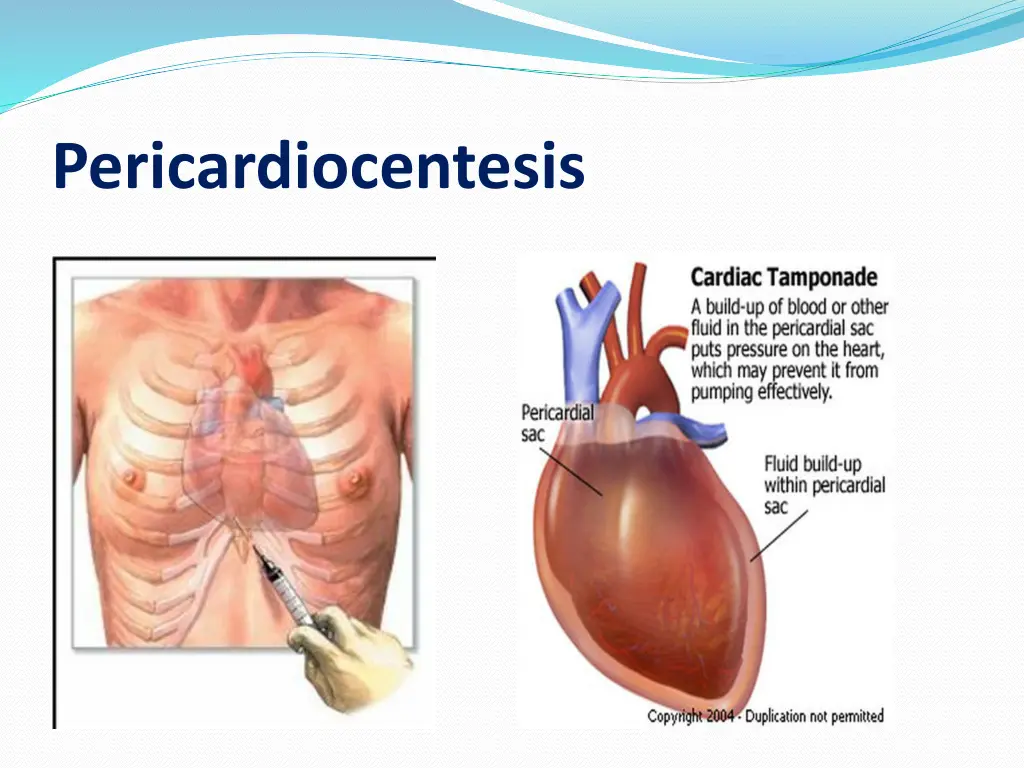 pericardiocentesis