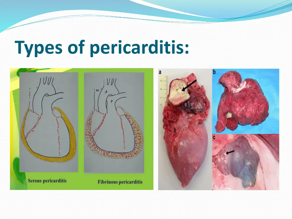 types of pericarditis 1