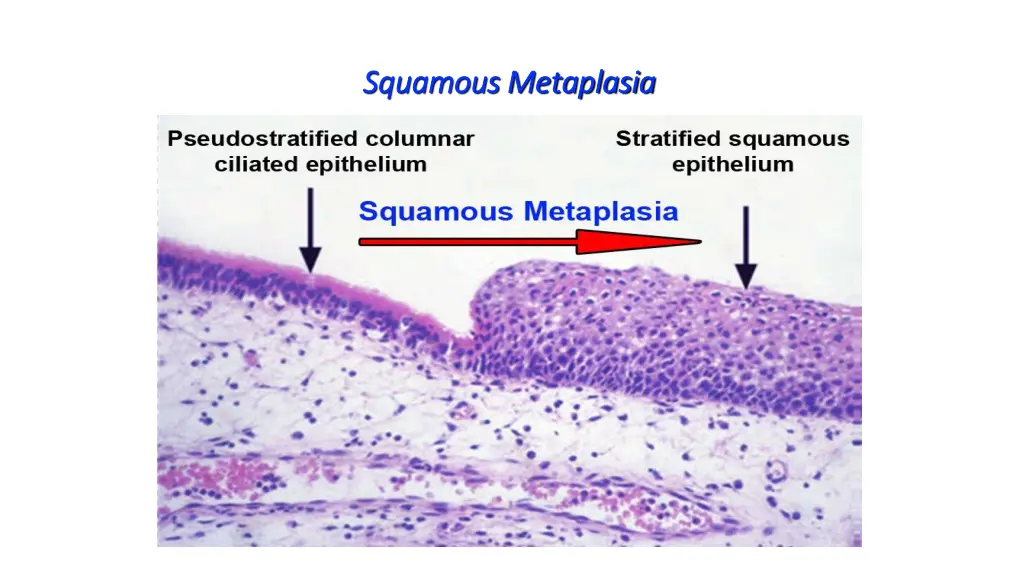 squamous metaplasia squamous metaplasia