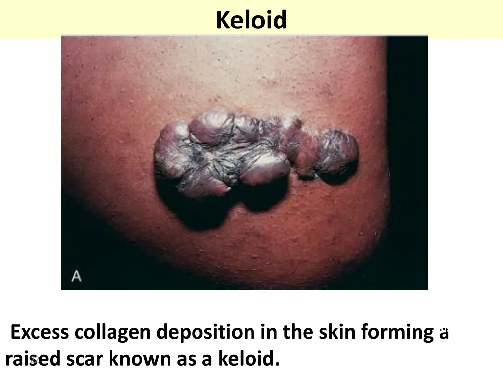 keloid