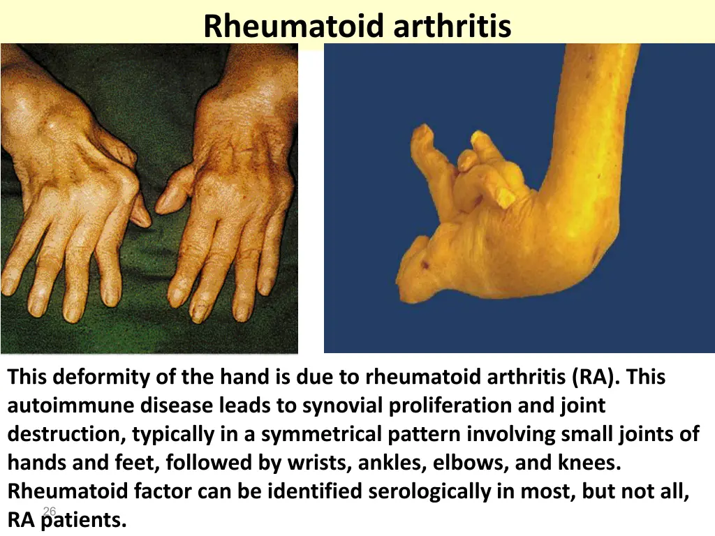 rheumatoid arthritis