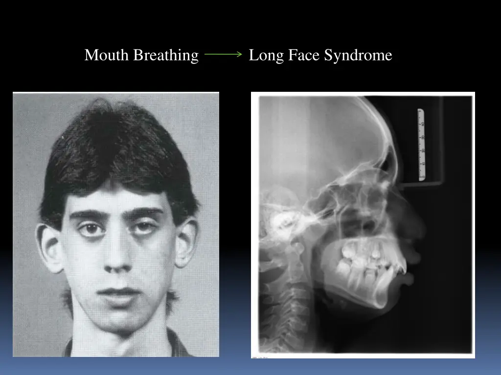 mouth breathing long face syndrome