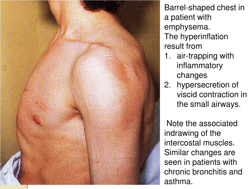 barrel shaped chest in a patient with emphysema