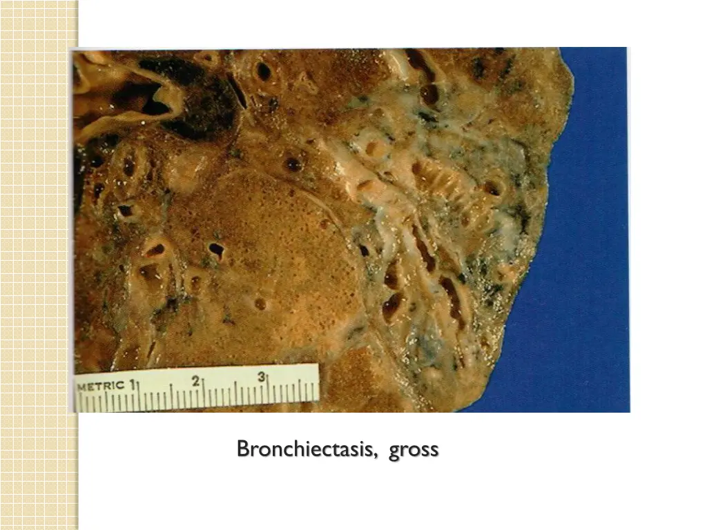 bronchiectasis gross