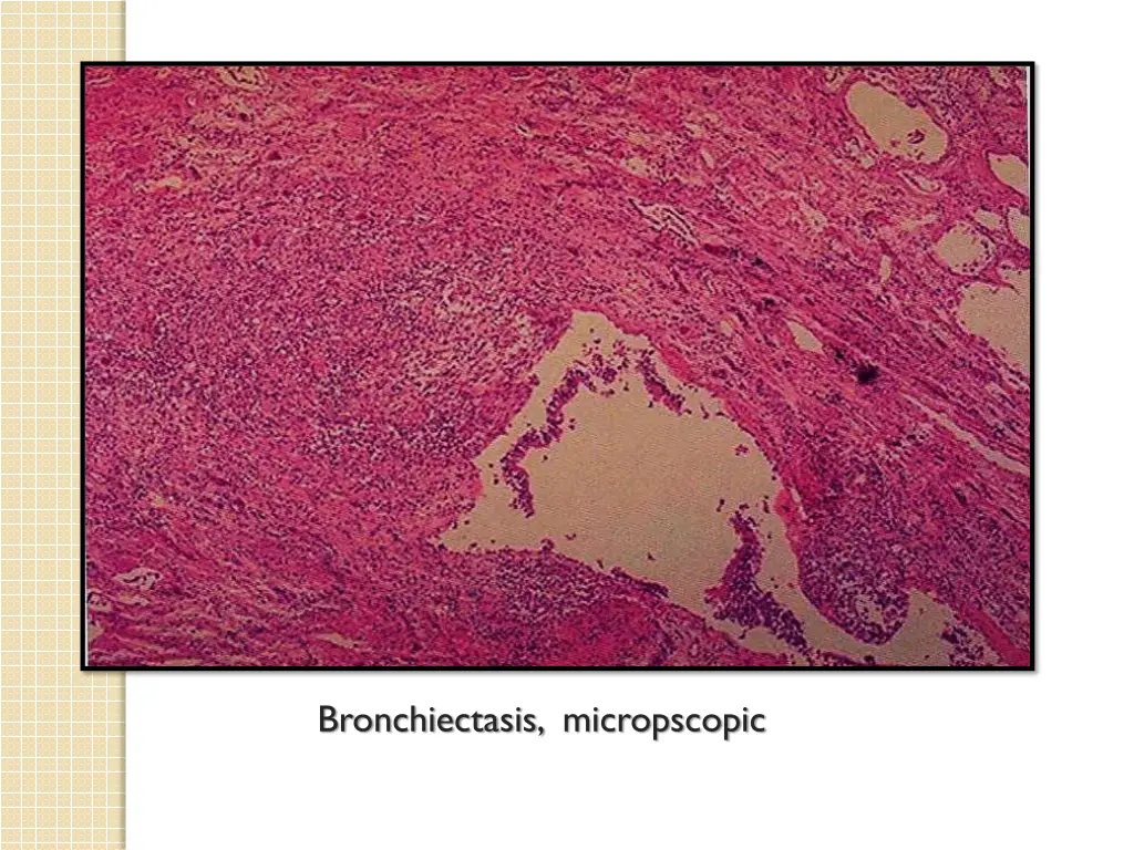 bronchiectasis micropscopic