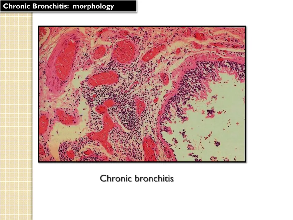 chronic bronchitis morphology 1