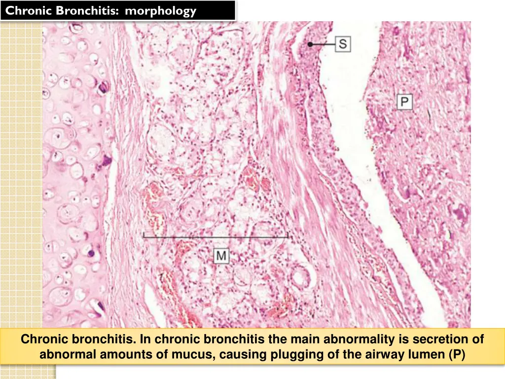 chronic bronchitis morphology 2