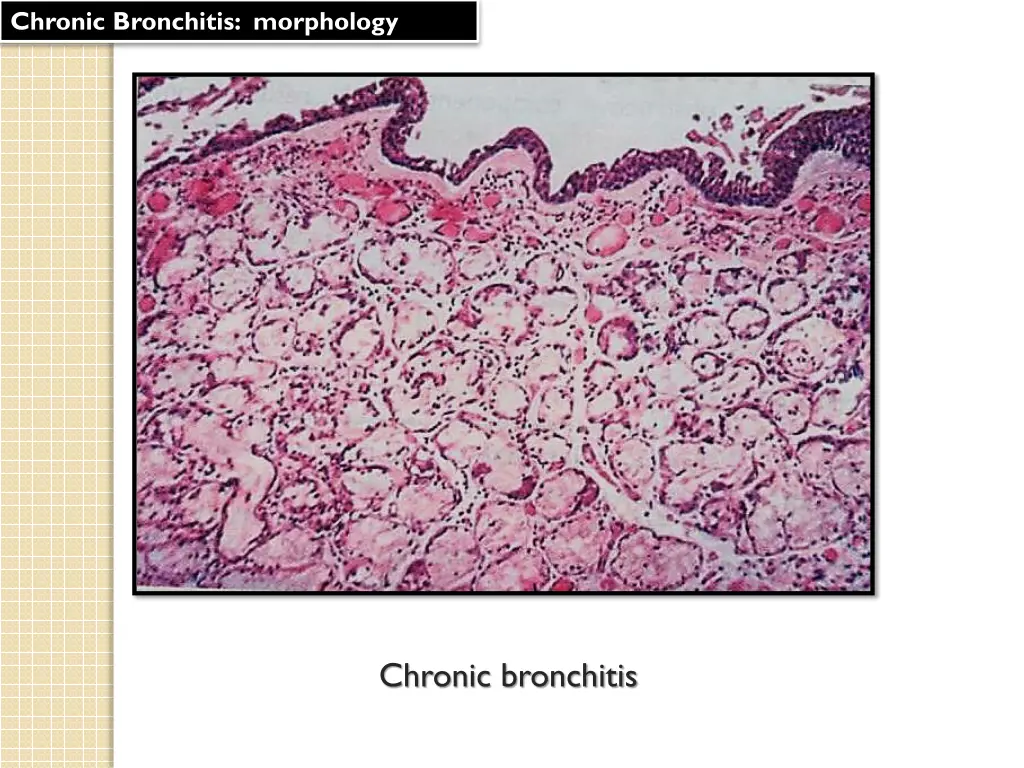 chronic bronchitis morphology