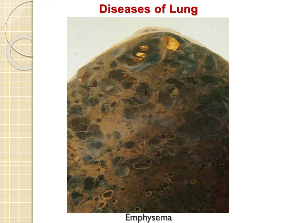 diseases of lung 1