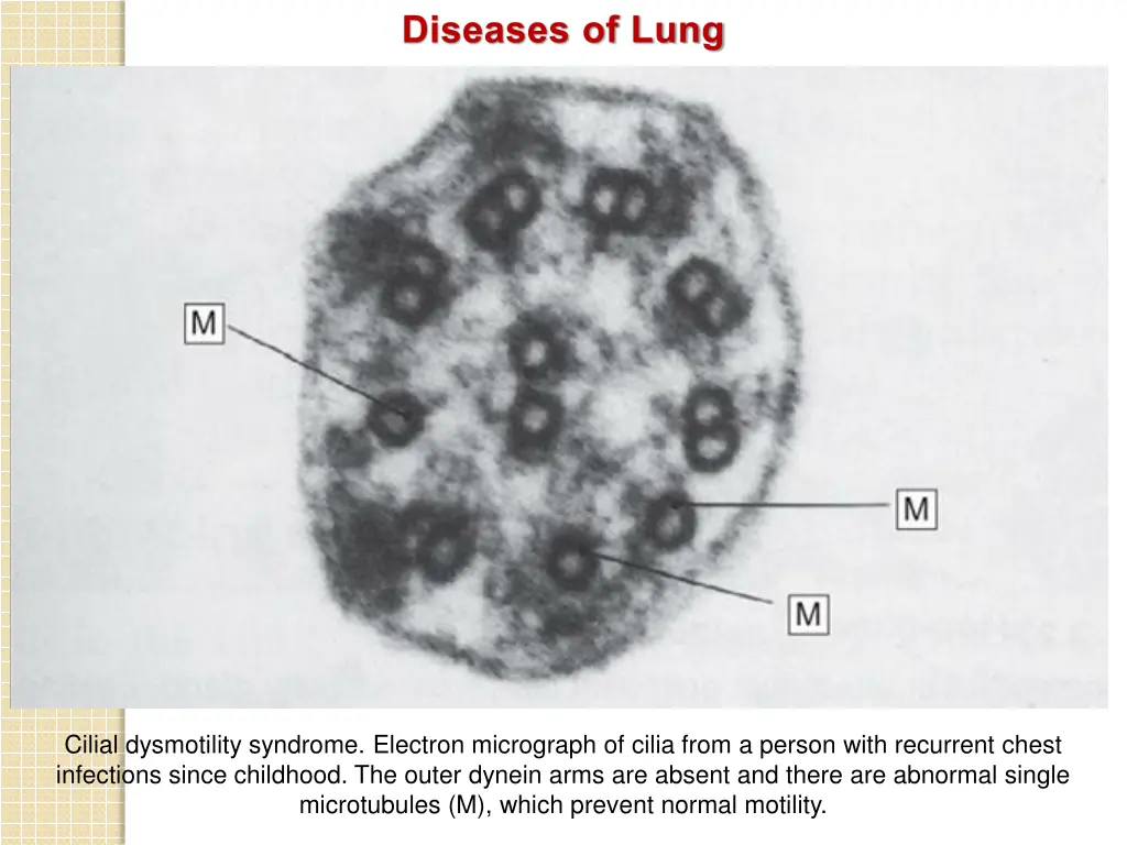 diseases of lung 2