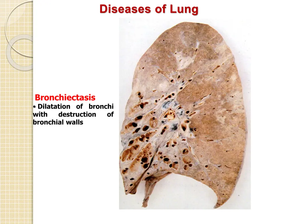 diseases of lung 3