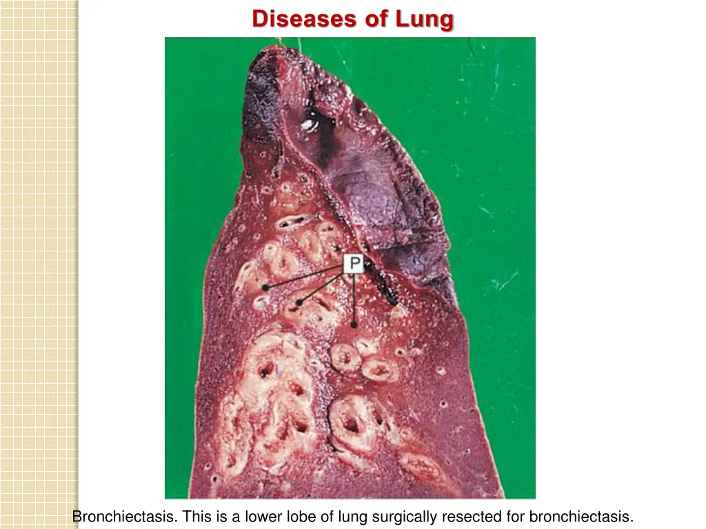 diseases of lung 4