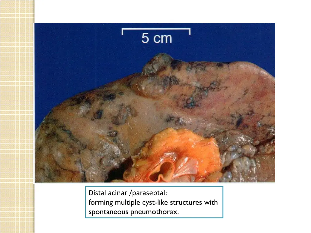 distal acinar paraseptal forming multiple cyst