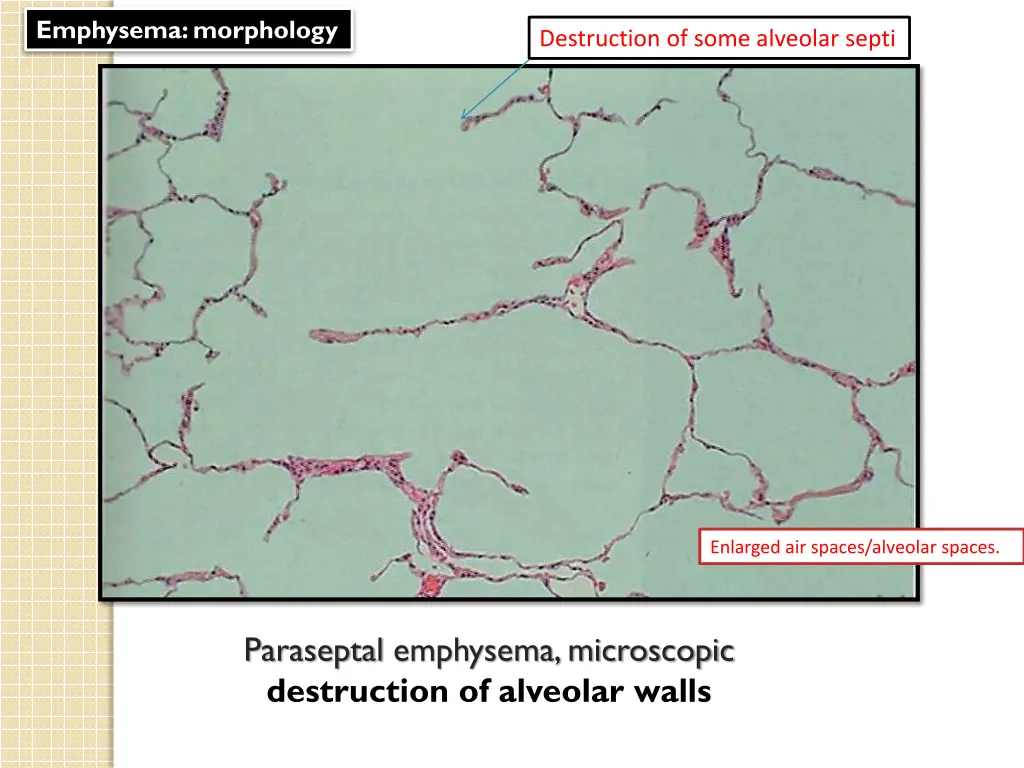 emphysema morphology 1