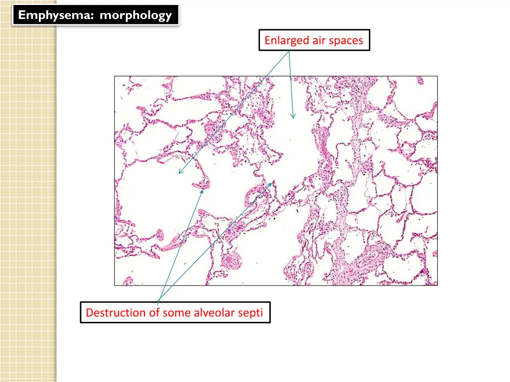 emphysema morphology 2