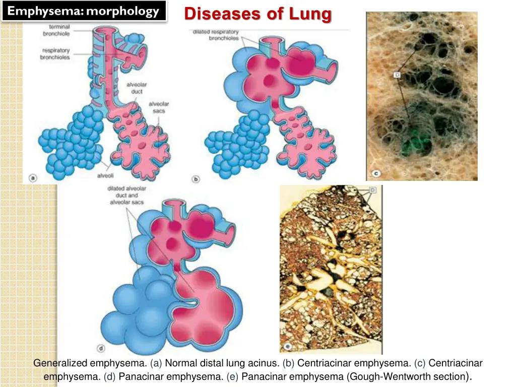 emphysema morphology