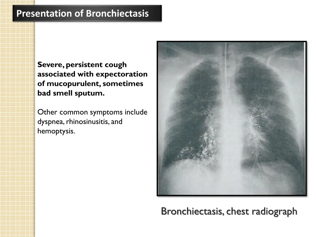 presentation of bronchiectasis