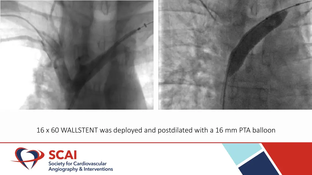 16 x 60 wallstent was deployed and postdilated