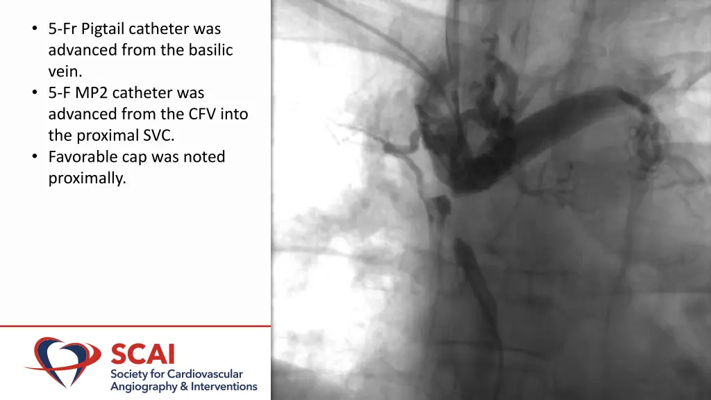 5 fr pigtail catheter was advanced from