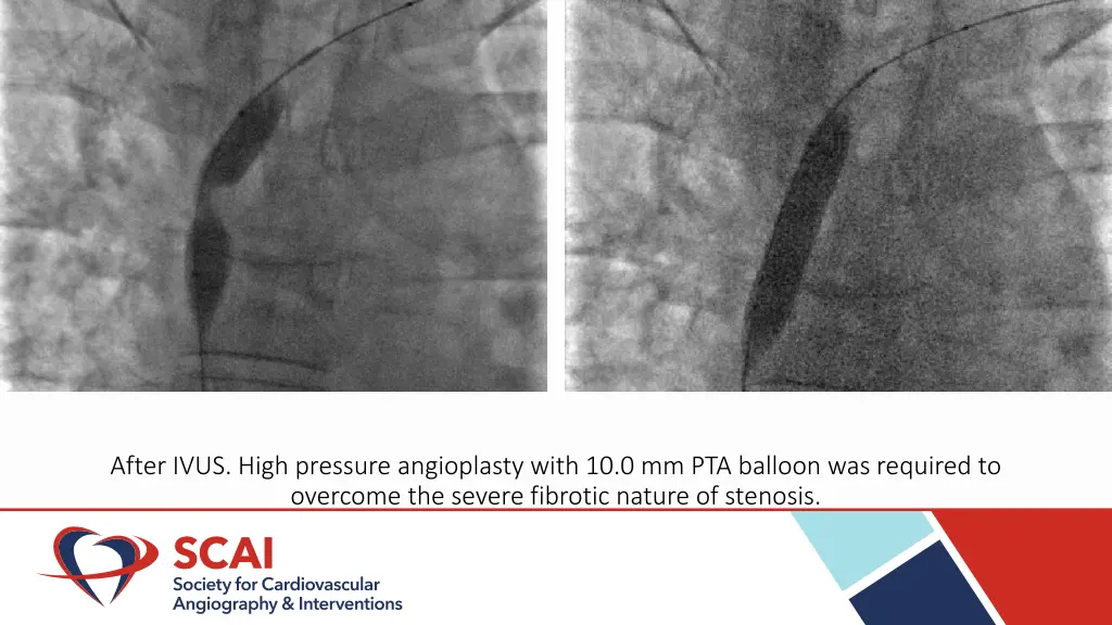 after ivus high pressure angioplasty with