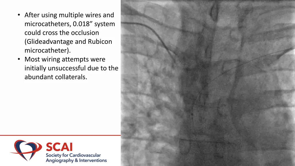 after using multiple wires and microcatheters