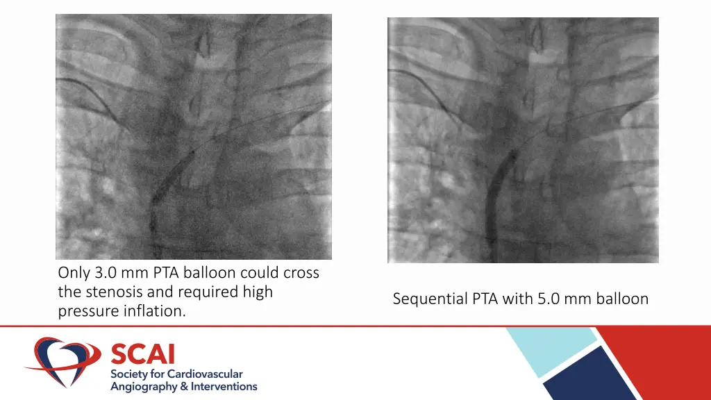 only 3 0 mm pta balloon could cross the stenosis